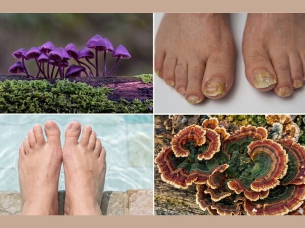 How to Treat Fungus